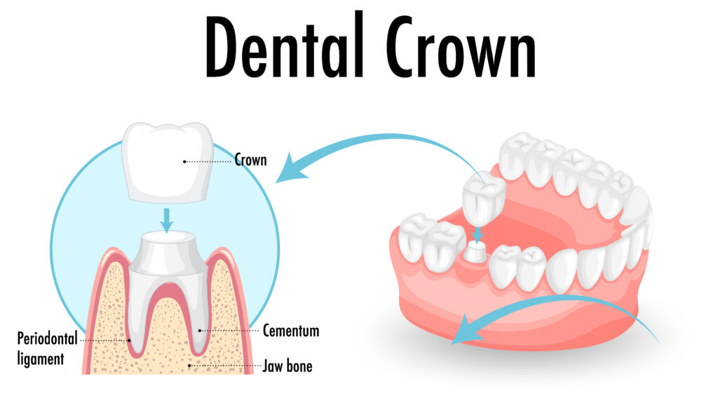 infographic of human in dental crown